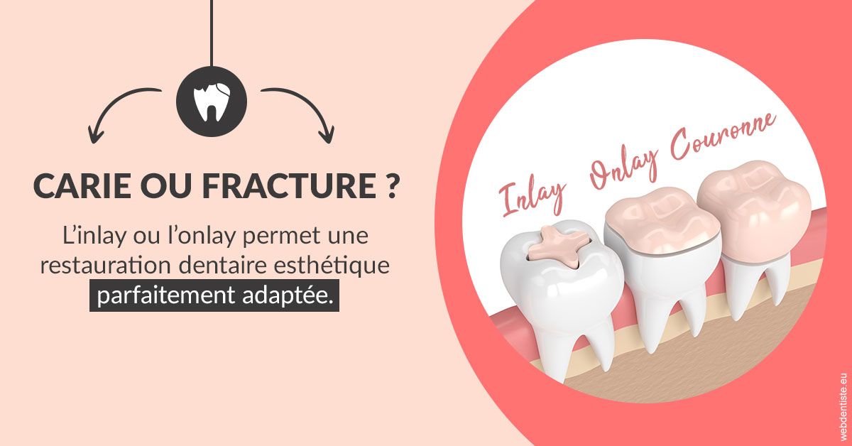 https://dr-laulhere-vigneau-jean-marc.chirurgiens-dentistes.fr/T2 2023 - Carie ou fracture 2