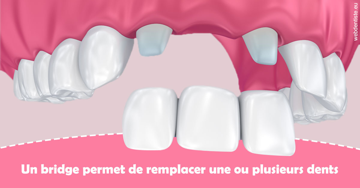 https://dr-laulhere-vigneau-jean-marc.chirurgiens-dentistes.fr/Bridge remplacer dents 2