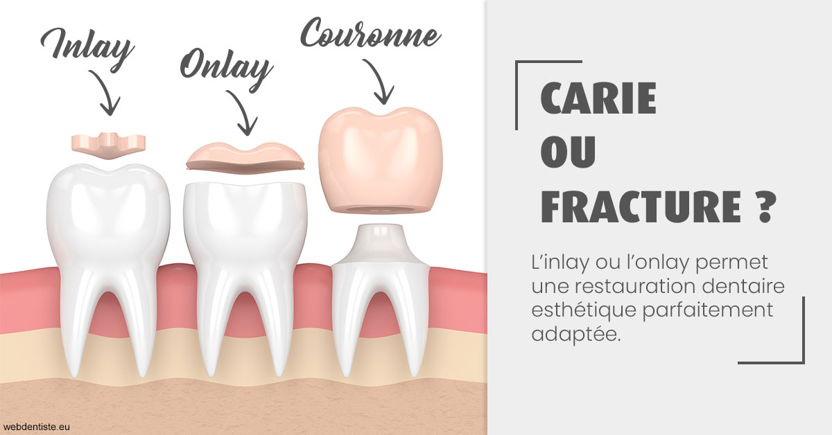 https://dr-laulhere-vigneau-jean-marc.chirurgiens-dentistes.fr/T2 2023 - Carie ou fracture 1