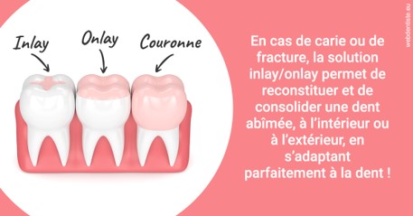 https://dr-laulhere-vigneau-jean-marc.chirurgiens-dentistes.fr/L'INLAY ou l'ONLAY 2