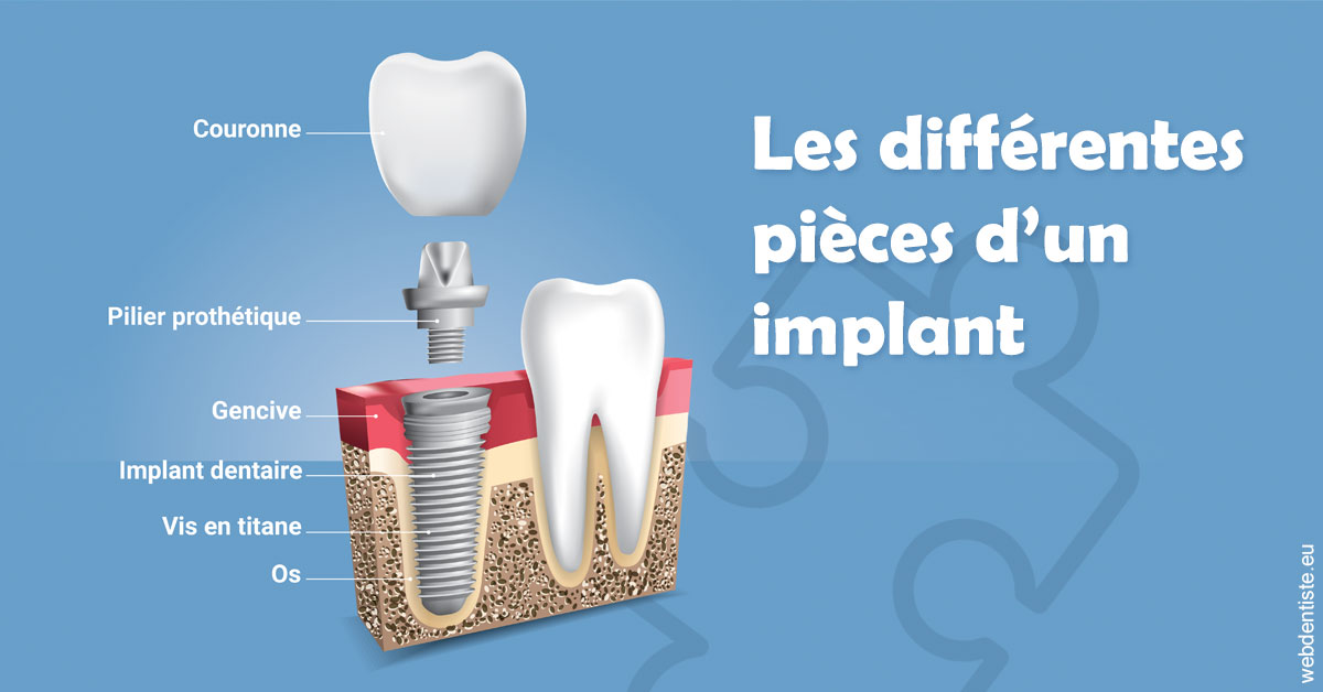 https://dr-laulhere-vigneau-jean-marc.chirurgiens-dentistes.fr/Les différentes pièces d’un implant 1